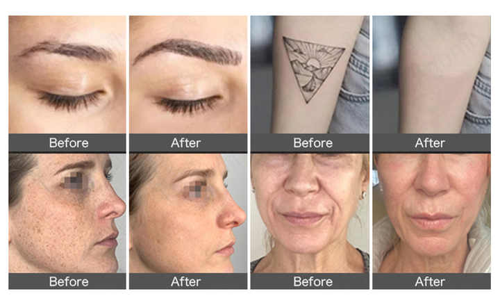 2 in 1 ND Yag Laser 3 Wavelength 755nm 808nm 1064nm Diode Laser Israel ...