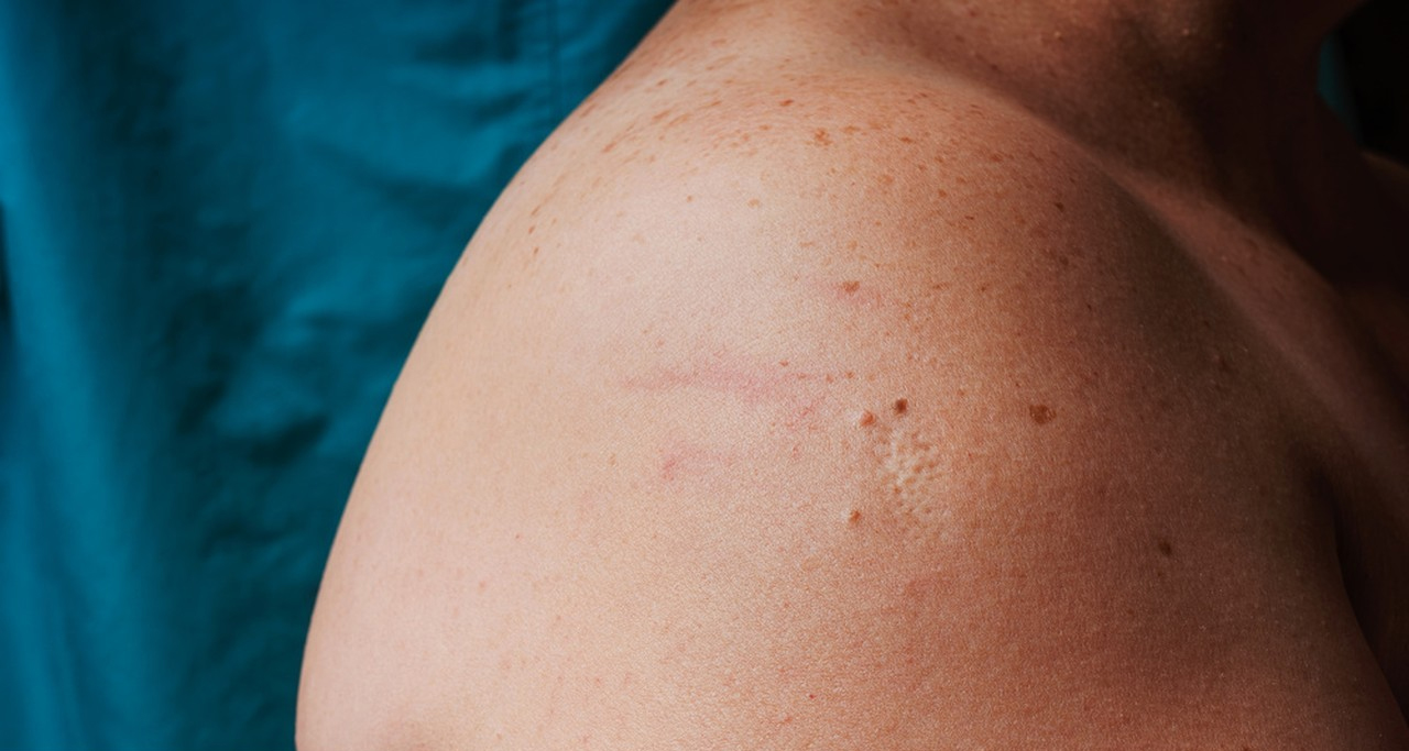 best treatments to remove age spots on hands