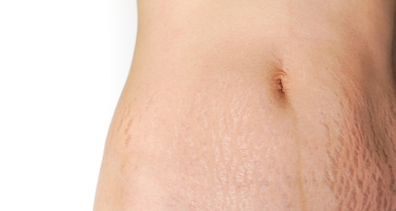 Say goodbye to stretch marks: Effective ways for removal