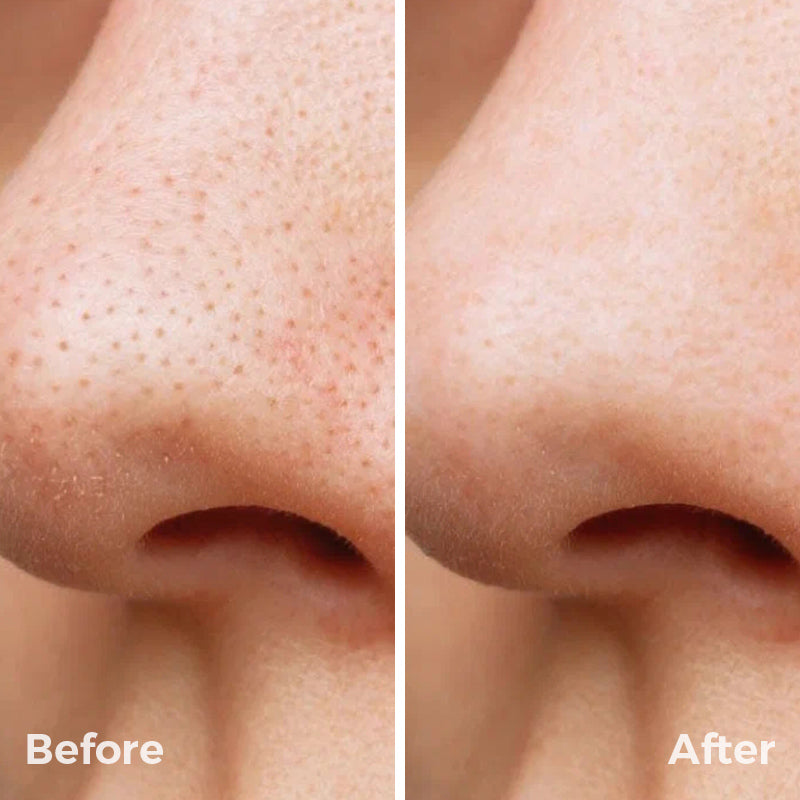 Rxmoore Blackhead Remover | Pore Vacuum with Camera