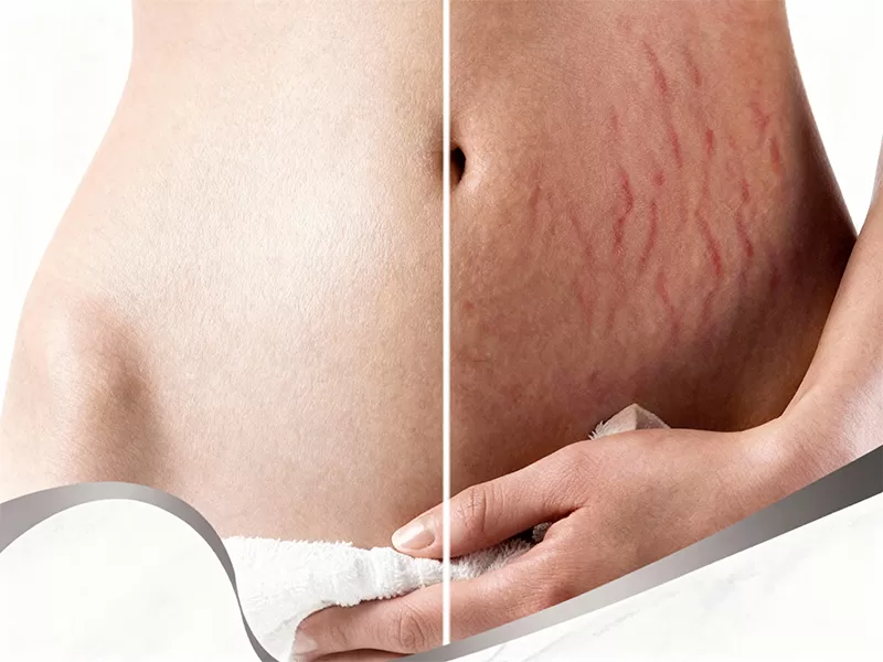 Top Laser Stretch Mark Removal Machines and Costs - PZLASER