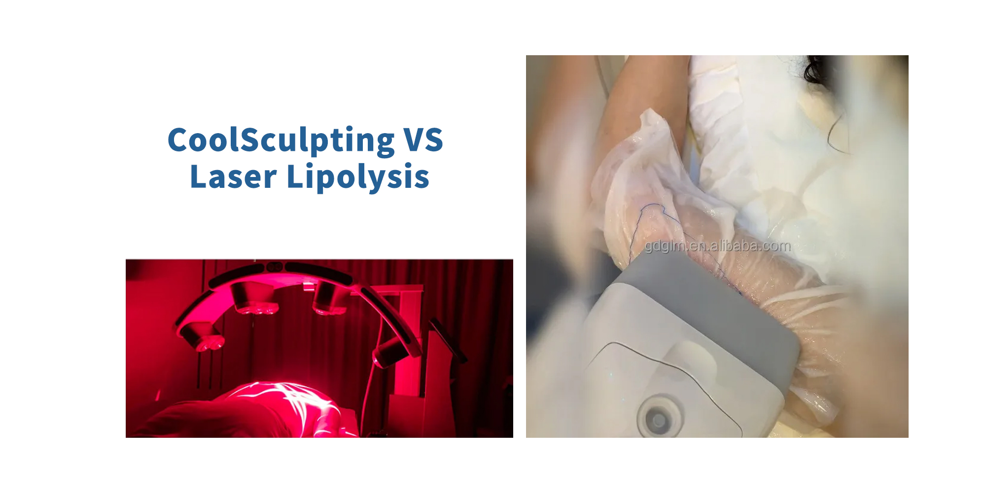 Comparing CoolSculpting and Laser Lipolysis: Which is Better?-GLM Beauty Spa Equipment Factory