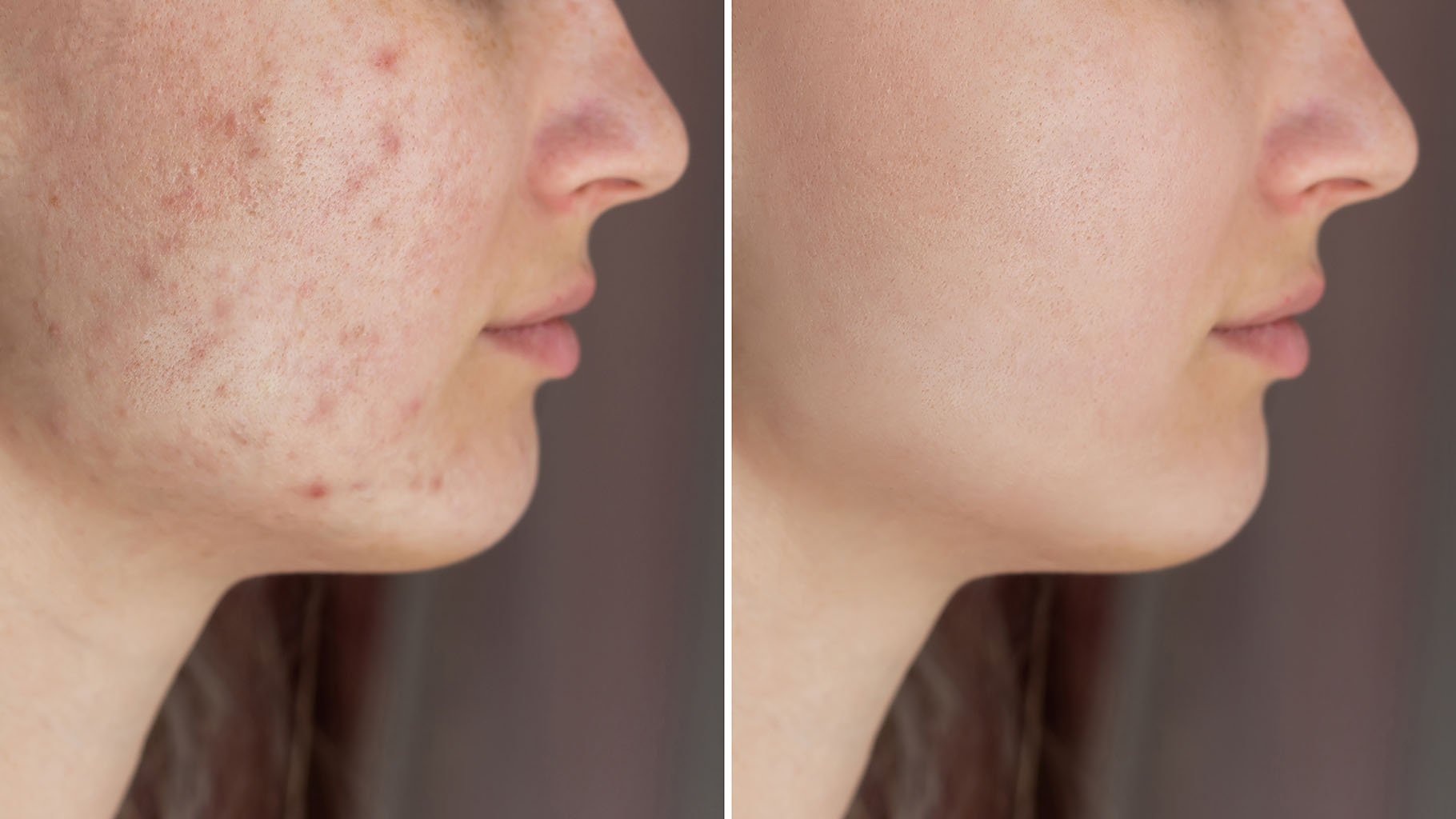 BBL Hero vs Traditional Acne Treatments: Which Works Best? - A Fine ...
