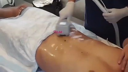 Portable BBL exilis ultrasound rf face lifting fat removal machine