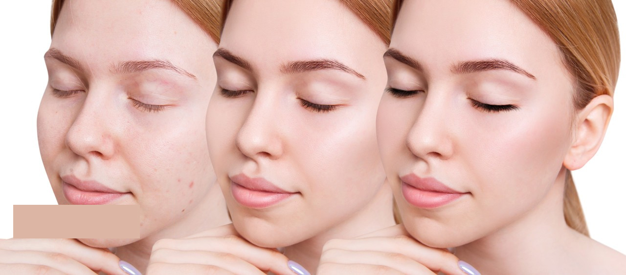 Fastest Way to Remove Facial Spots: Laser Spot Removal