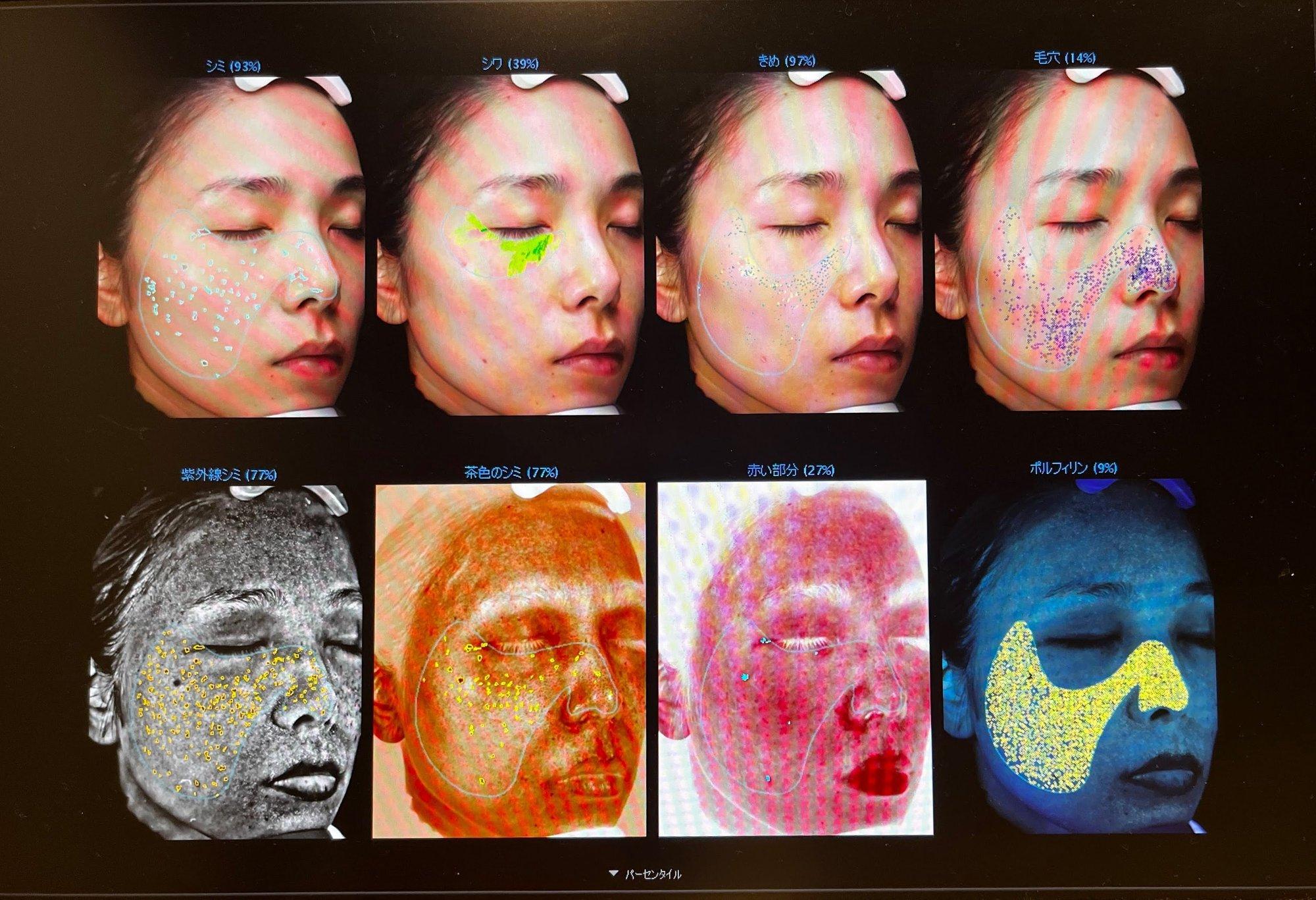 肌を調べる。鼻の毛穴に悩むアラサーが「VISIA肌診断」をやってみた｜みなみやん｜ご自愛とセルフケア