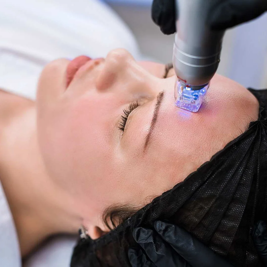 1 Scarlet RF + 1 Full Face Meso Session | YaraOnline