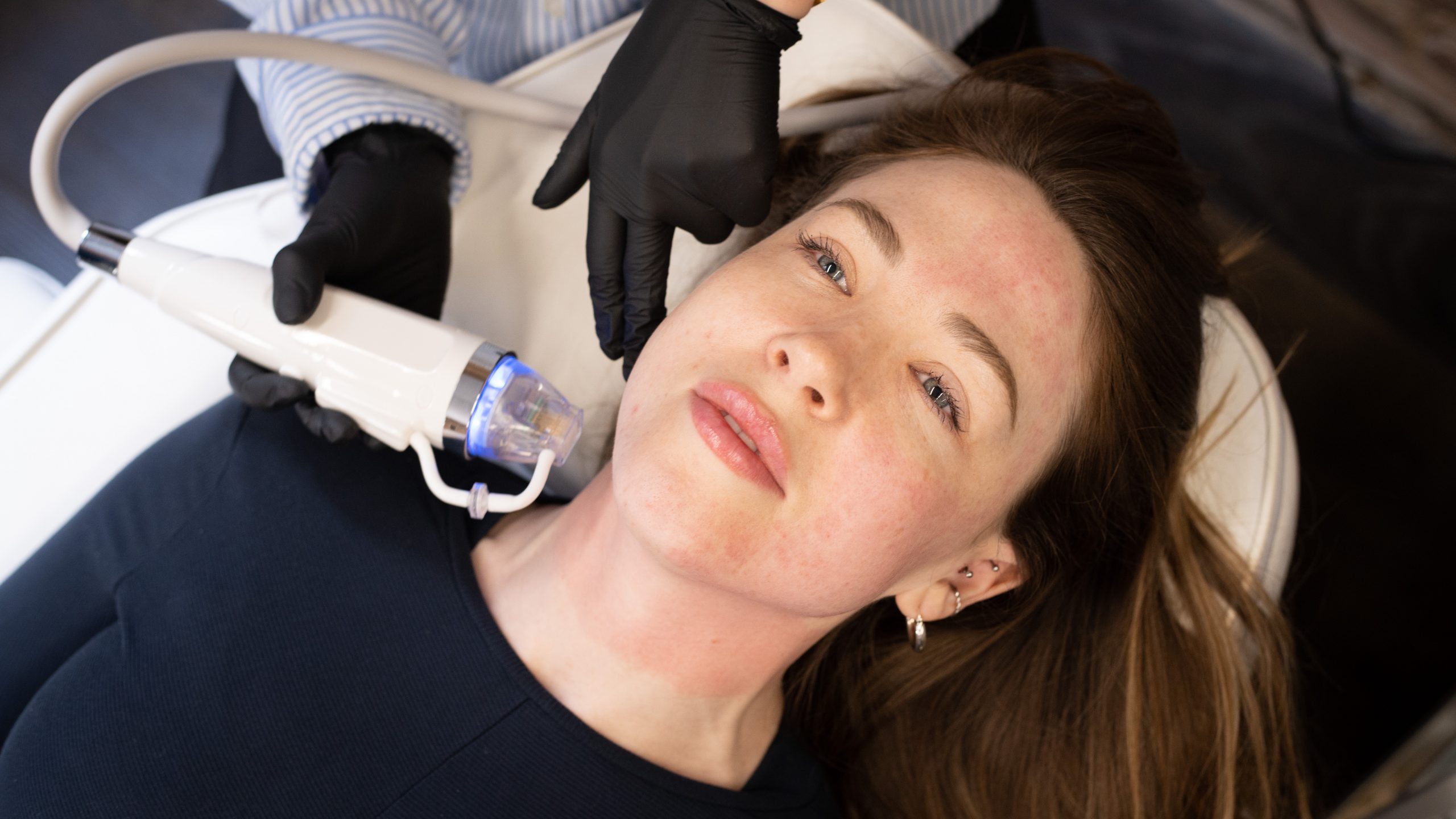 Everything you need to know about Radiofrequency Microneedling &mdash; Tweak East
