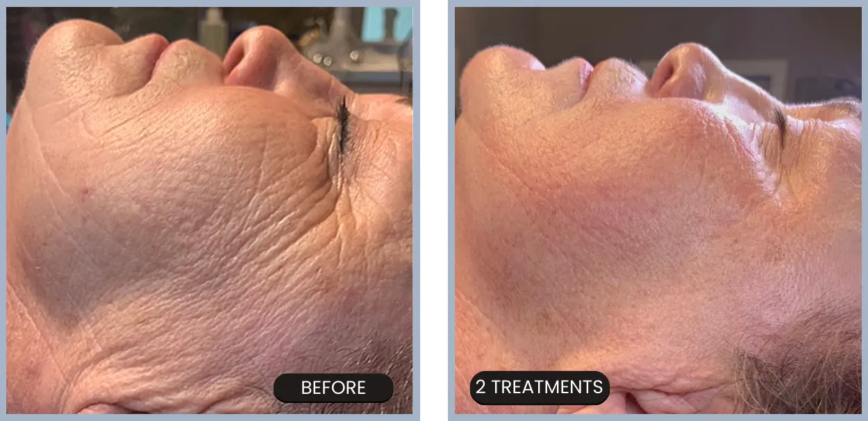 No-Needle Mesotherapy: Rejuvenation Without Injection!