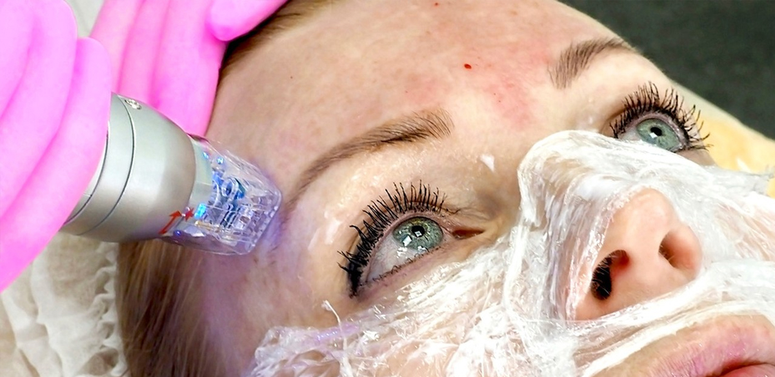 what is morpheus8 microneedling benefits after care?