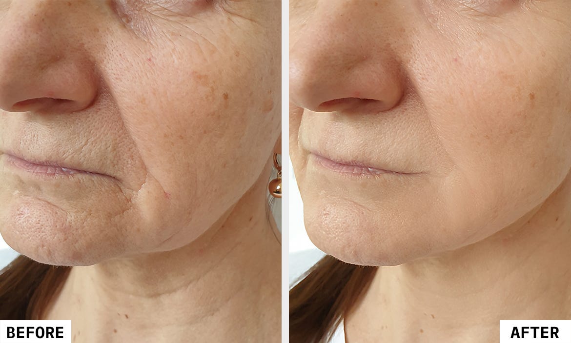 HIFU Facial: Advanced Skin Tightening Treatment| Kaya