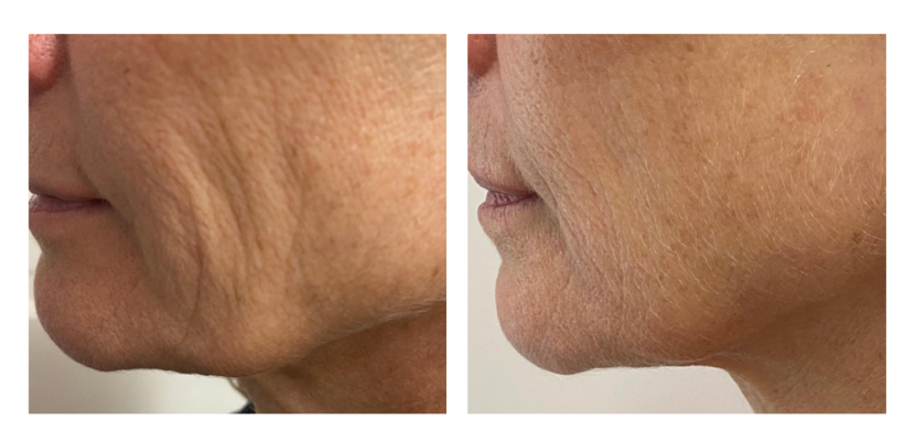 Hifu Treatment: Transform Your Skin