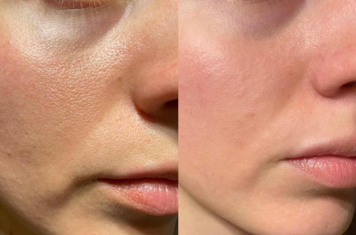 Microneedling: A Clinically-Proven Approach to Skin Renewal | Radio ...