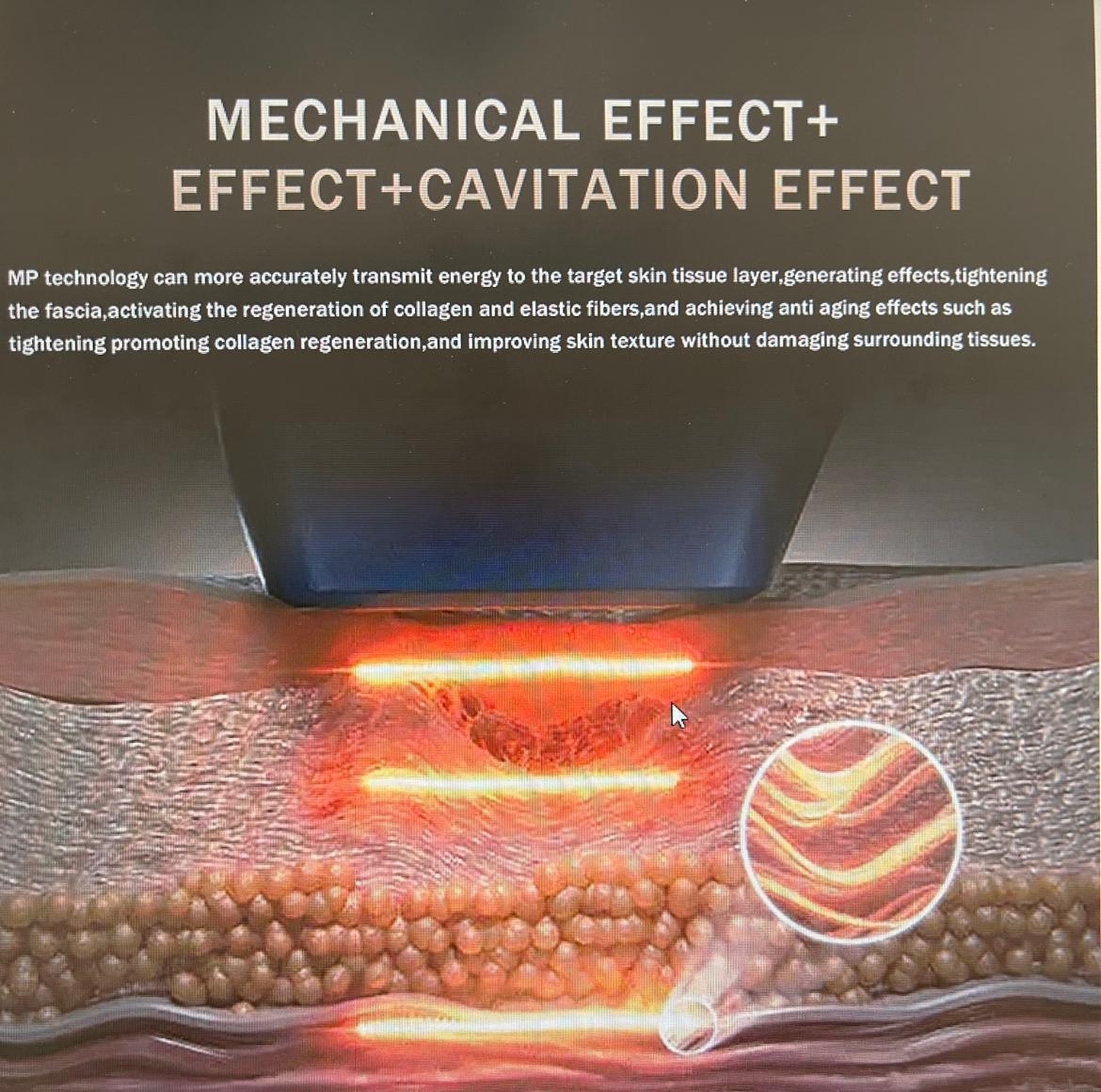 Ultrasound Cavitation - BE Laser