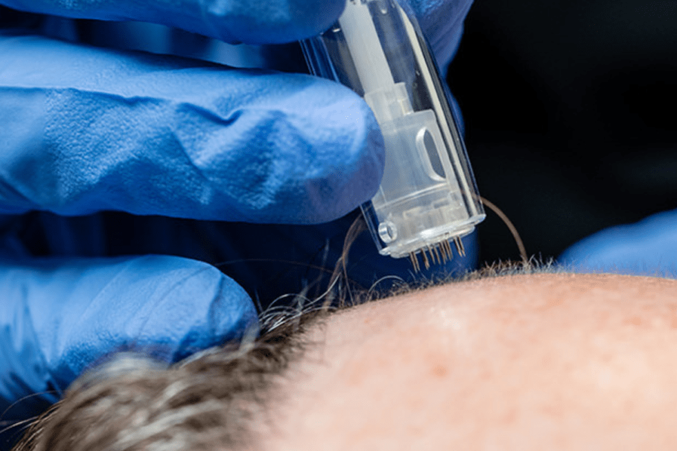 Enhance Your Skin Health: Combining PRP and Microneedling - Be ...