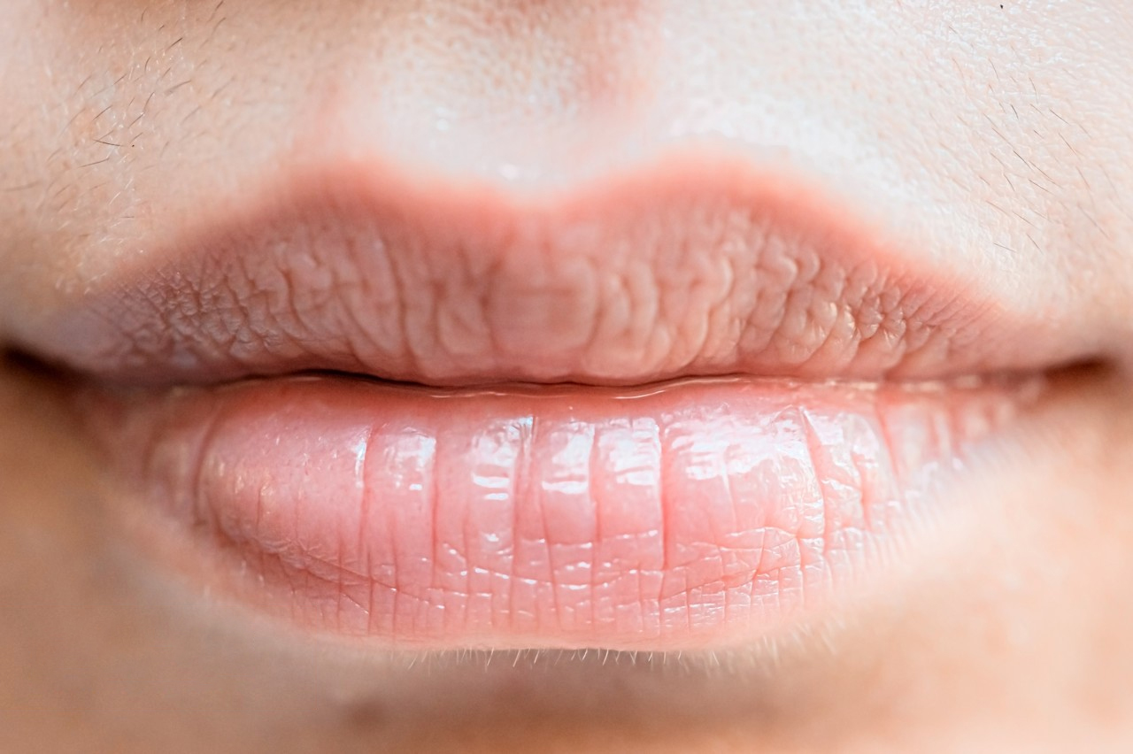 Smooth Away Upper Lip Lines: Discover the Non-Surgical Treatments