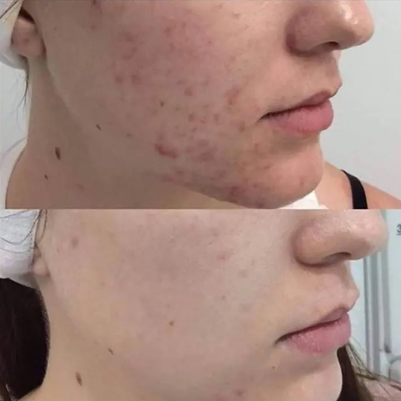 Portable secret rf microneedling device