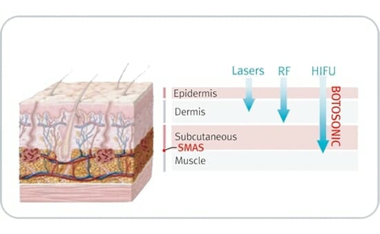 HIFU Face Lift | Estetica Sweden
