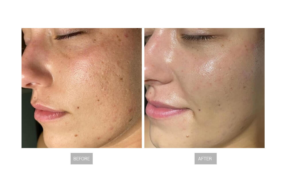 13 in 1 Hot Bubble Hydra Oxygen Dermabrasion Facial Machine - konmison