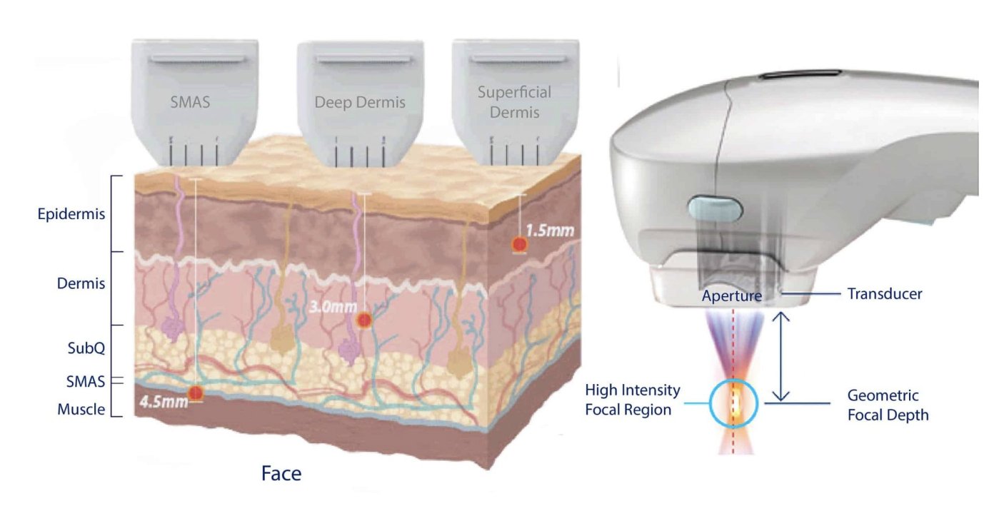 HIFU : Non-surgical Face Lifting in Singapore