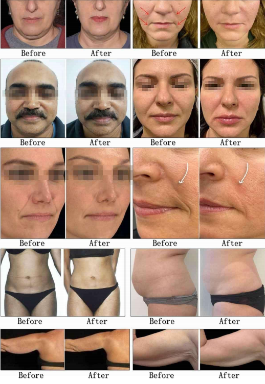 A61 Cryo/Cooling HIFU Vmax High Intensity Focused Ultrasound Smas Lift Machine