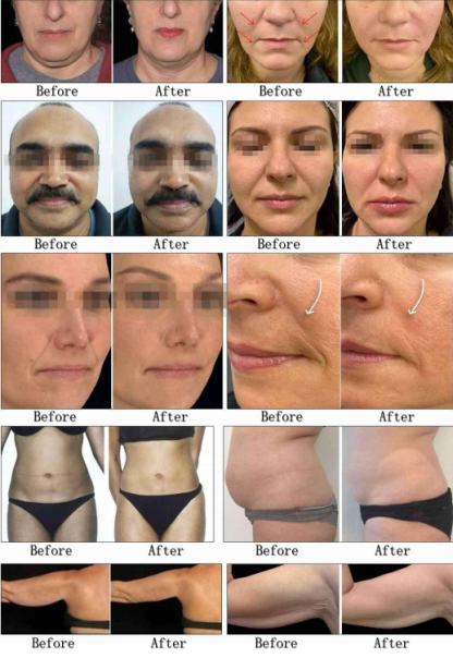 A61 Cryo/Cooling HIFU Vmax High Intensity Focused Ultrasound Smas Lift Machine