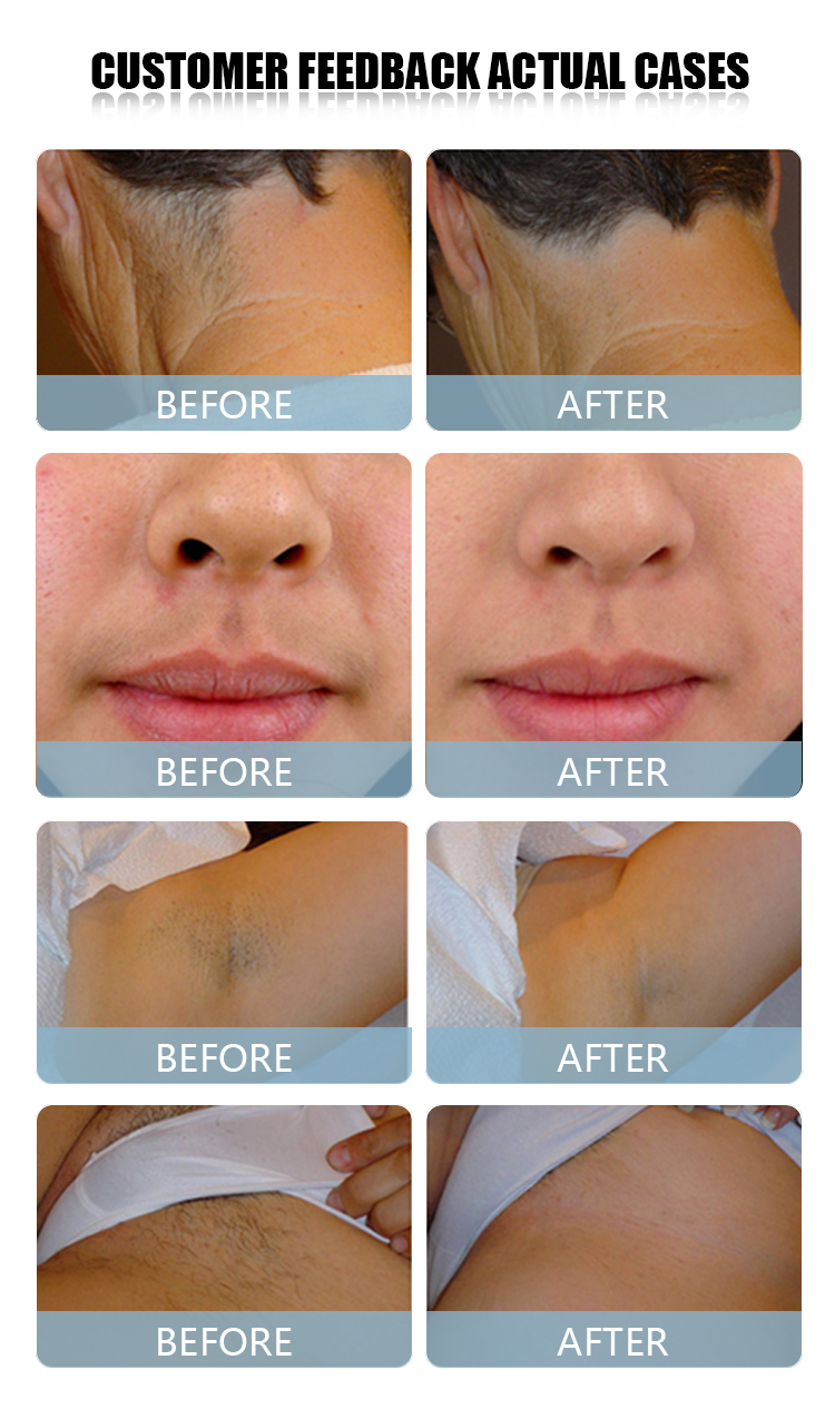 808nm diode laser hair removal machine