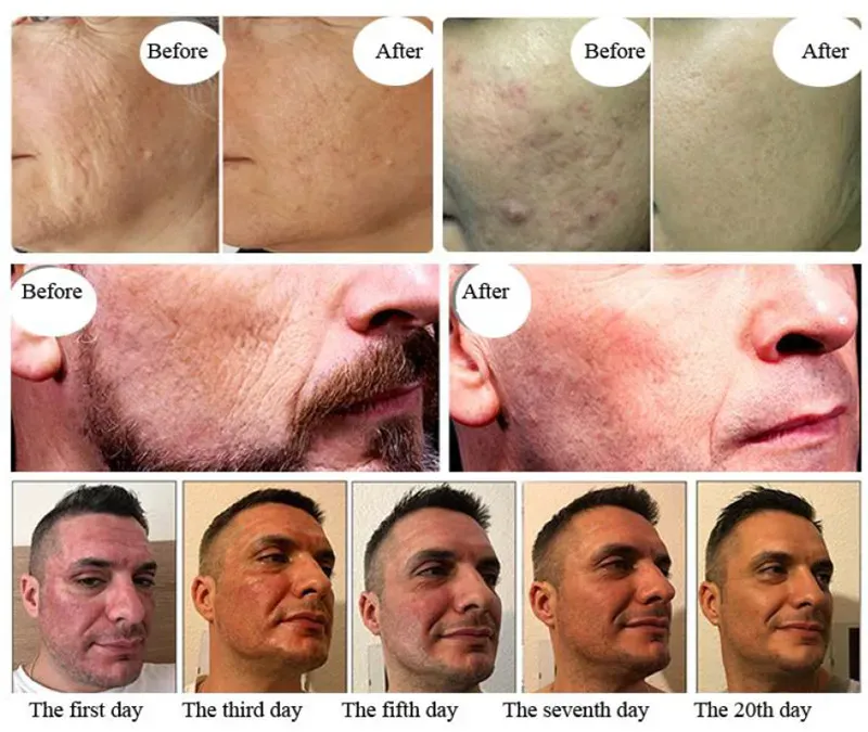 F-020 Pro TMA Thermo-Mechanical Action Fractional Face & Body Scar Removal Machine