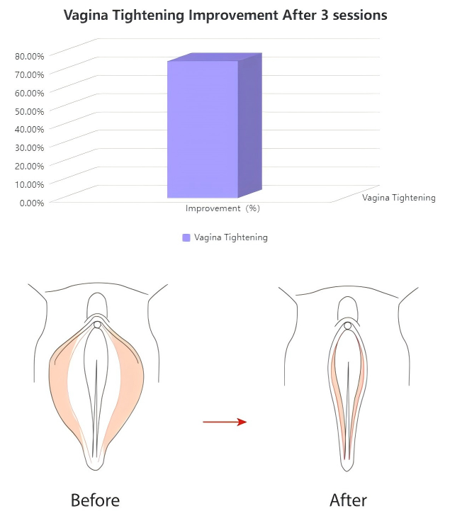 F-046  360° Private Care RF Vagina Tightening Beauty Device