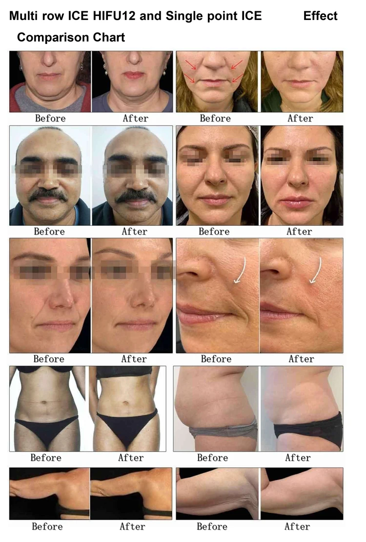 最佳冷冻Hifu机无痛Morpheus8 7厘米深度去除痤疮毛孔收缩装置冷柄射频机商业水疗使用