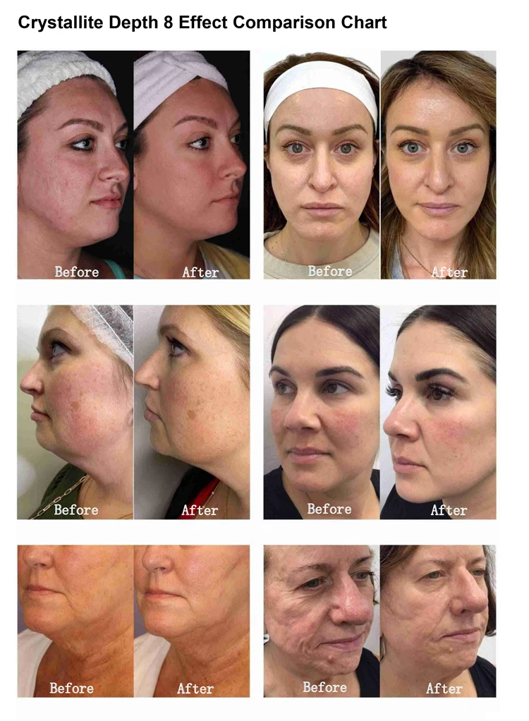 最佳冷冻Hifu机无痛Morpheus8 7厘米深度去除痤疮毛孔收缩装置冷柄射频机商业水疗使用