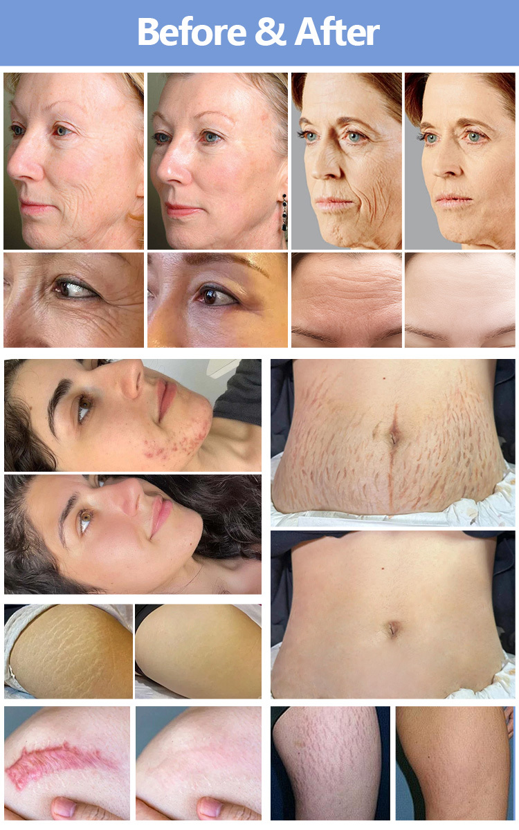 6in1 Skin Fairy Inmedor Amazing Fractional RF SkinPen Skin Care Equipment