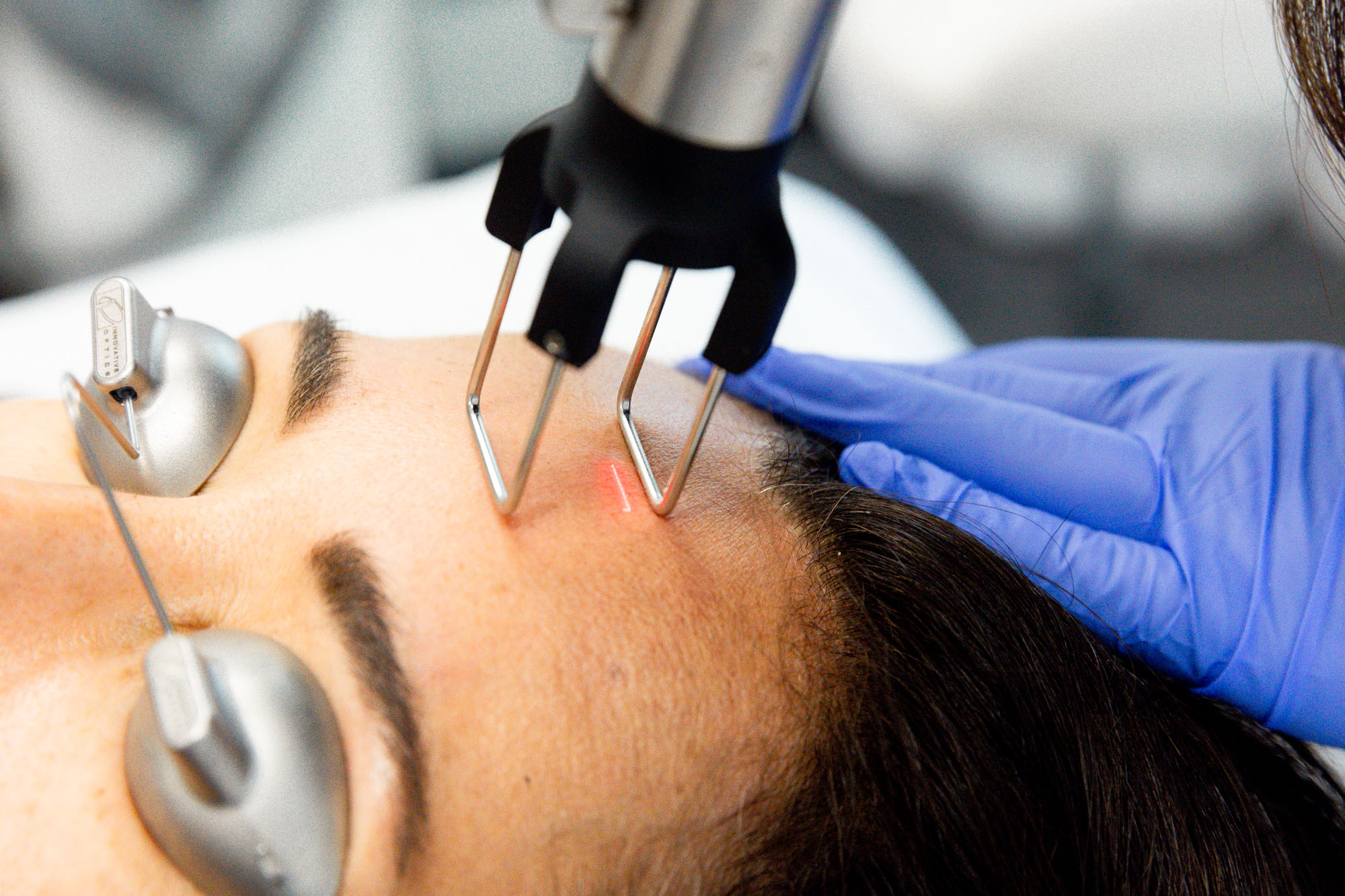 Fractional Technology Explained: Why It’s Gentler and More Effective-GLM Beauty Spa Equipment Factory