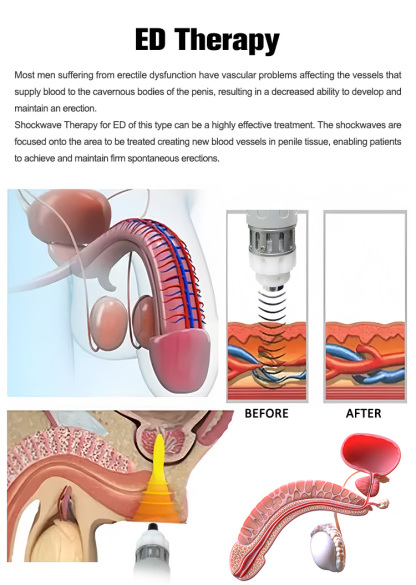 SW931 3IN1 Shock Wave EMS Pressotherapy Lymphatic Drainage Pain Relief Machine