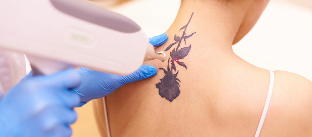 ND YAG Laser for Tattoo Removal Explained-GLM Beauty Spa Equipment Factory