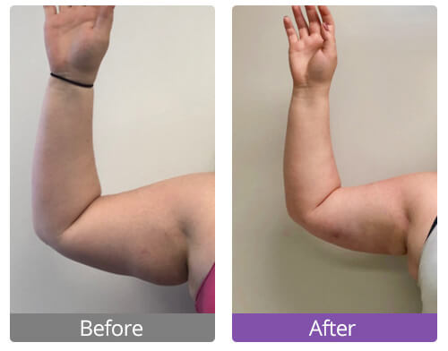 Ultrasonic Cavitation at Home | Before and After (With Photos)