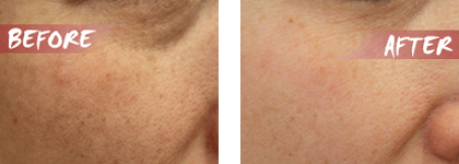 Meso Injector&trade; | Professional Multiuse Mesotherapy Injection Device