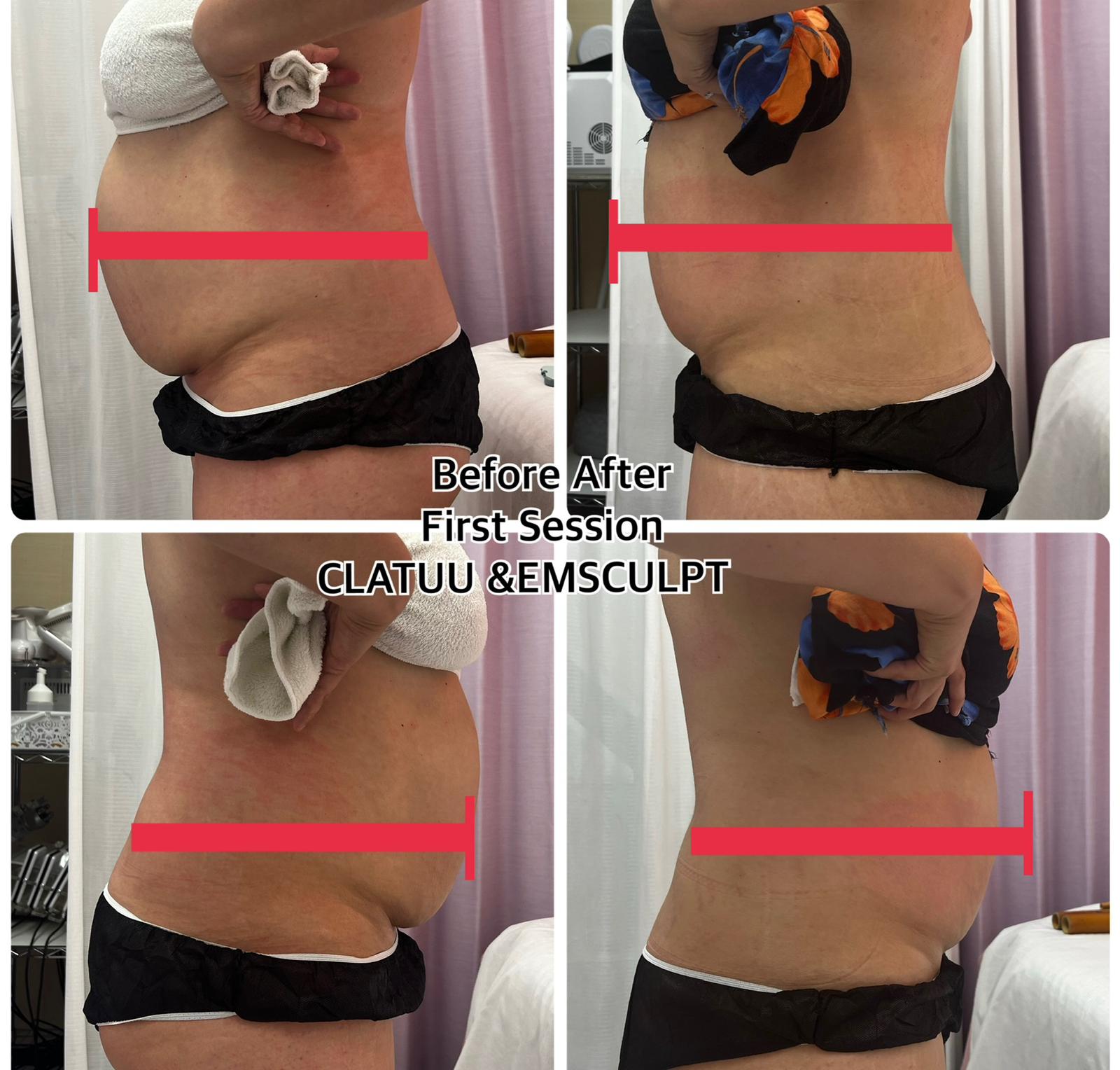 F39 2in1 Emslim EMS sculpting HIFEM Cryolipolisis 360 Cryo Therapy Fat Freezing Body Slimming Machine