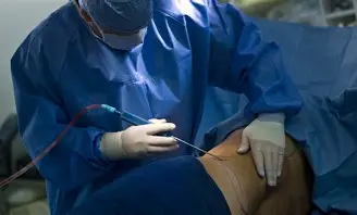 Liposuction 的图像结果