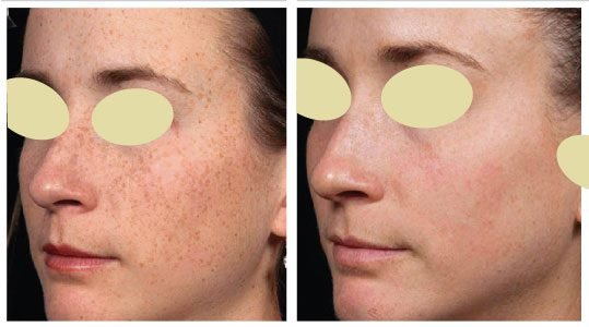 Microdermabrasion in Queens NY | Improves your Skin at 100%