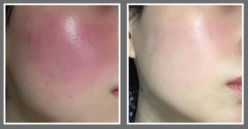 Professional Home Cold Plasma Pen for Skin Lifting - Ibeier Technology