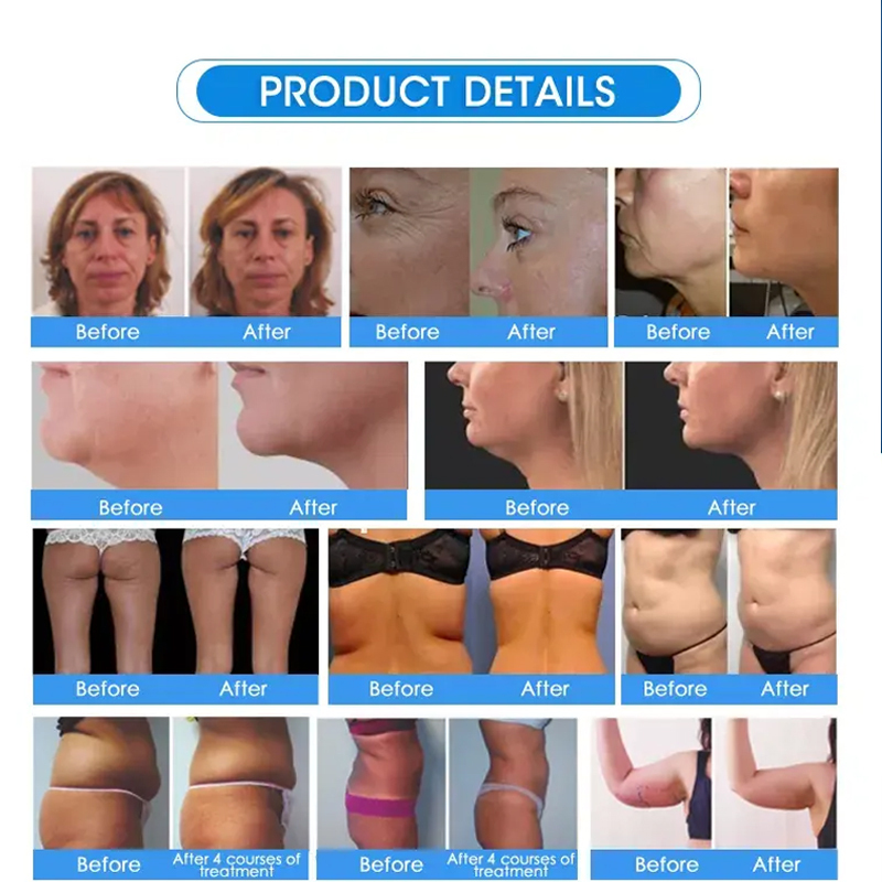 Portable BBL exilis ultrasound rf face lifting fat removal machine