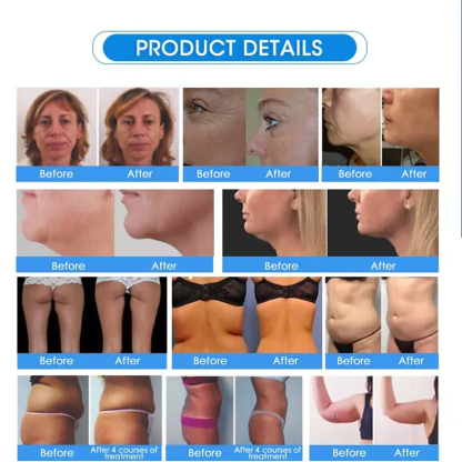 Portable BBL exilis ultrasound rf face lifting fat removal machine