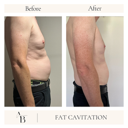 Fat Cavitation | Aspects Of Beauty