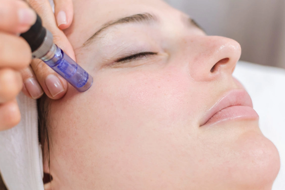 Is Microneedling Effective and Safe for Acne Scars?