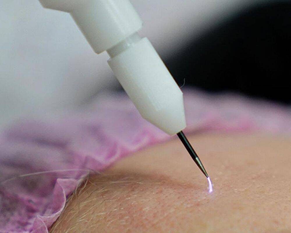 Cold Plasma Resurfacing & Rejuvenation | Professional Beauty by Elena