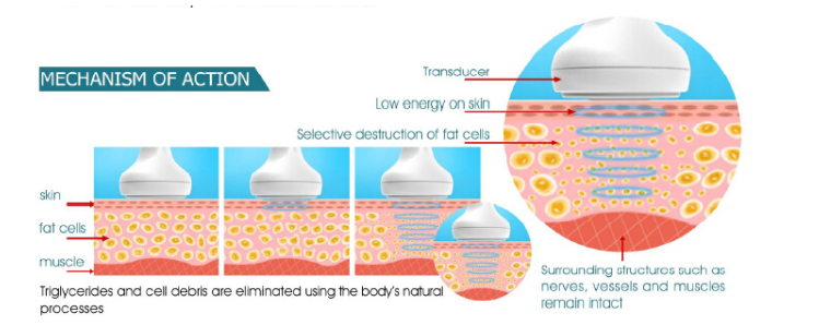 ULTRASOUND CAVITATION/ RADIO FREQUENCY — Estevan Laser Health Clinic