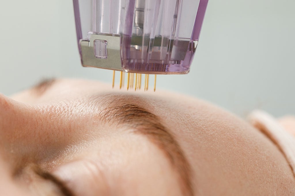 Acne treatment with monopolar radiofrequency needling