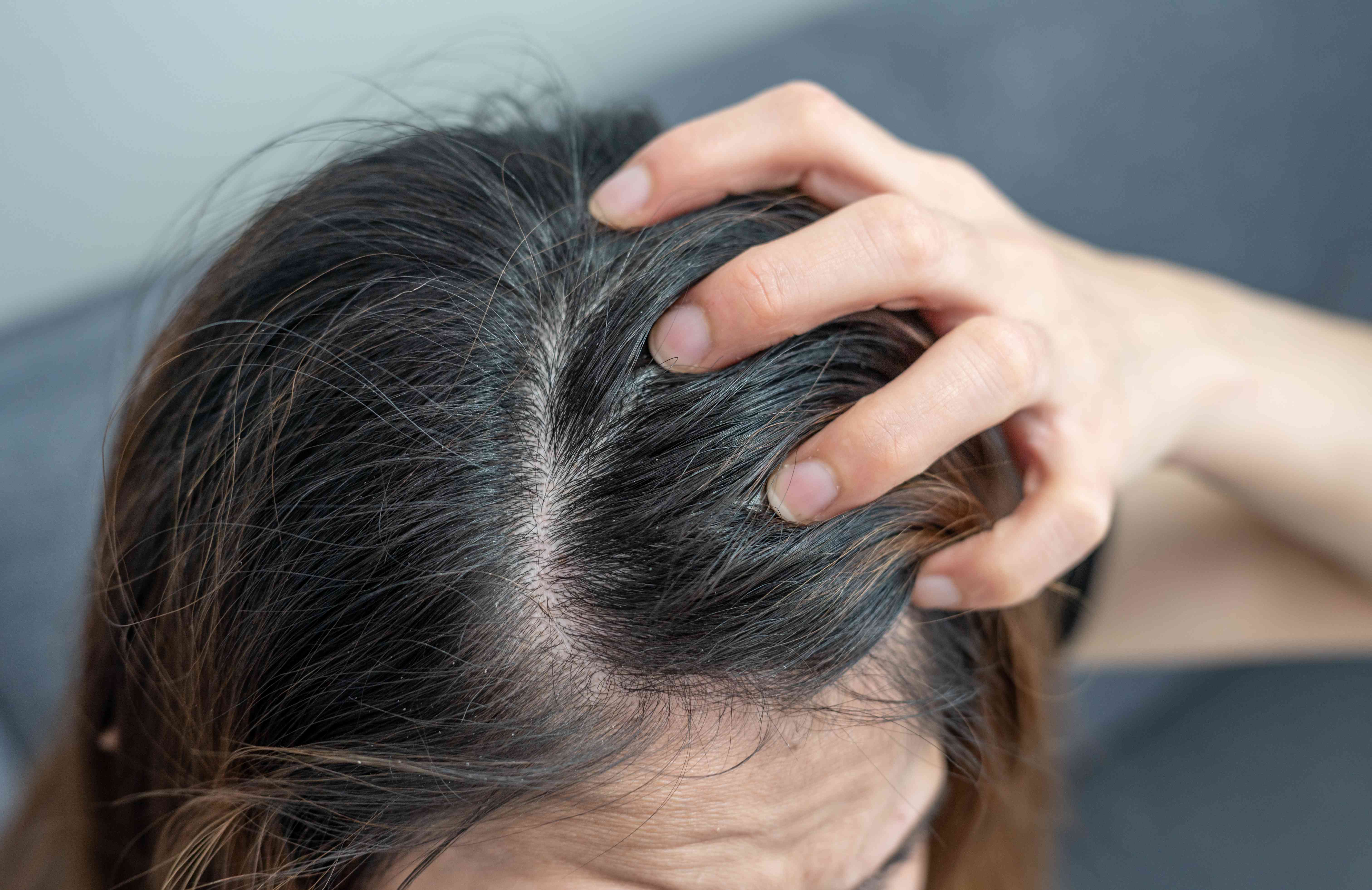 Itchy Scalp: Causes, Treatment, and Prevention