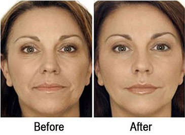 HIFU - Non Surgical Facelift